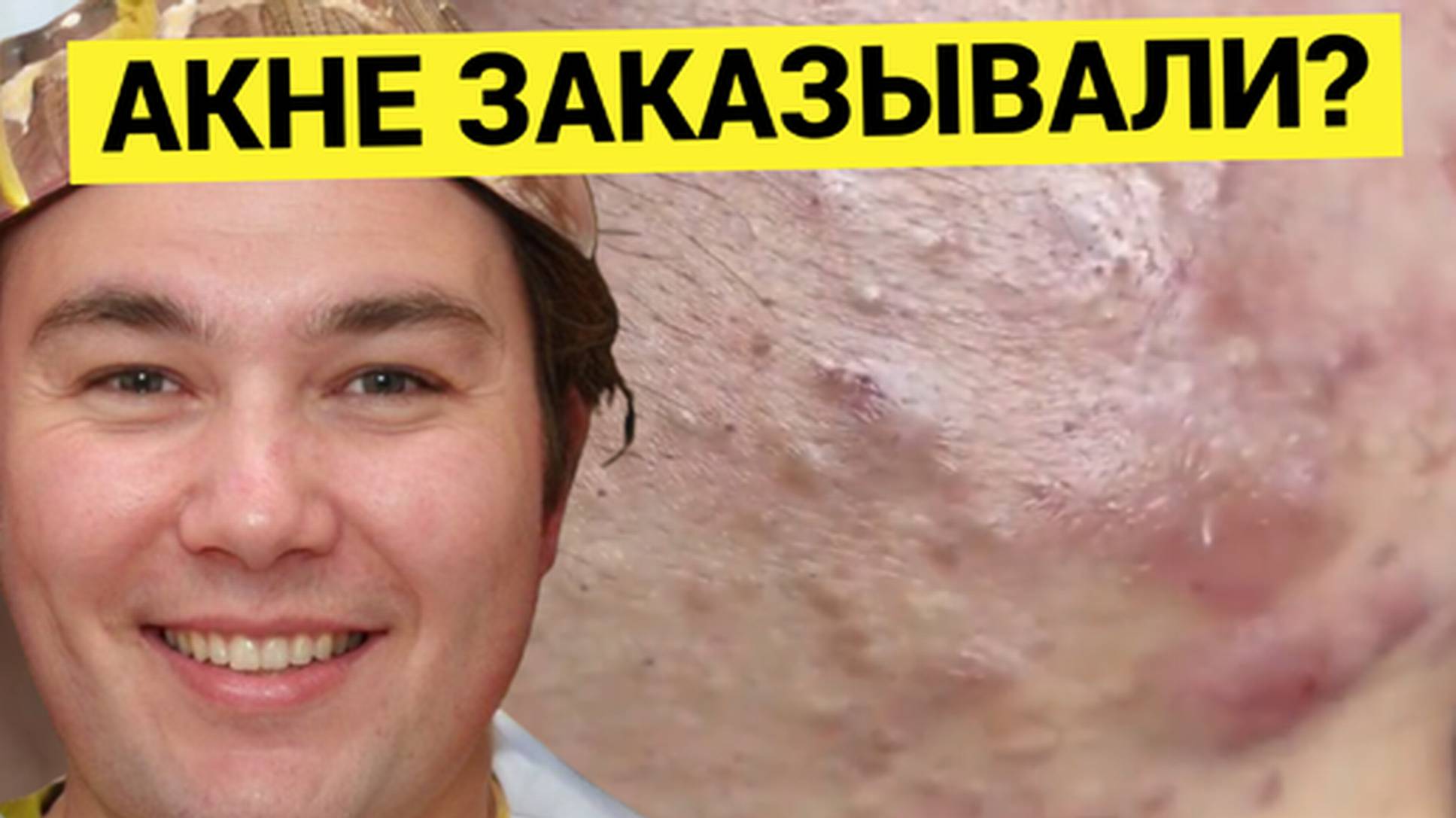 Сильное АКНЕ, Мастер Чистит Быстро и Аккуратно, Хотя и Непросто
