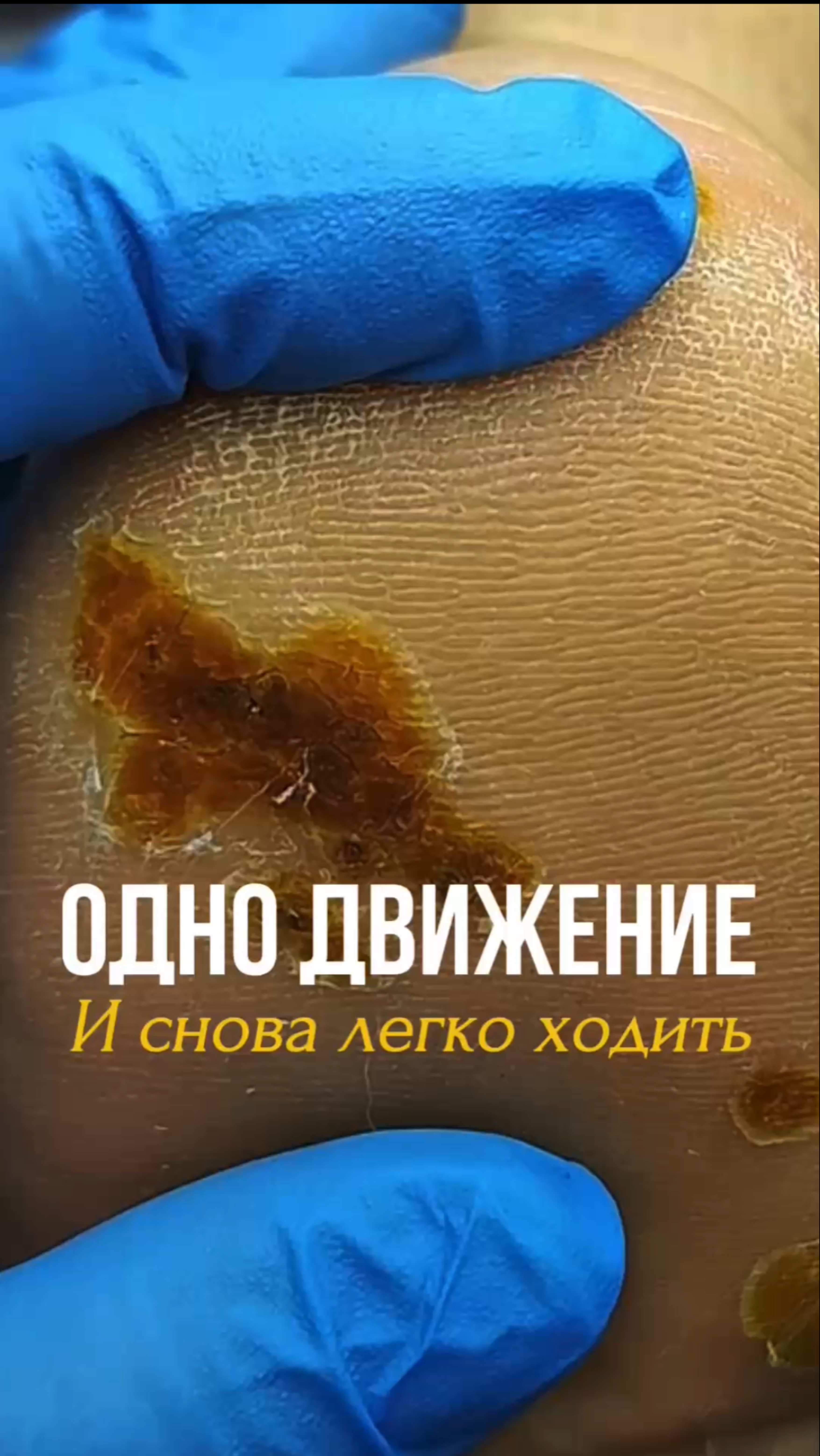 В этом видео вы увидите профессиональную работу нашего подолога.