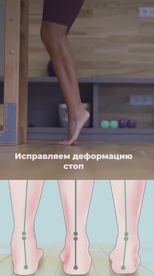 Исправляем деформацию стоп. Подпишись и читай описание❤️