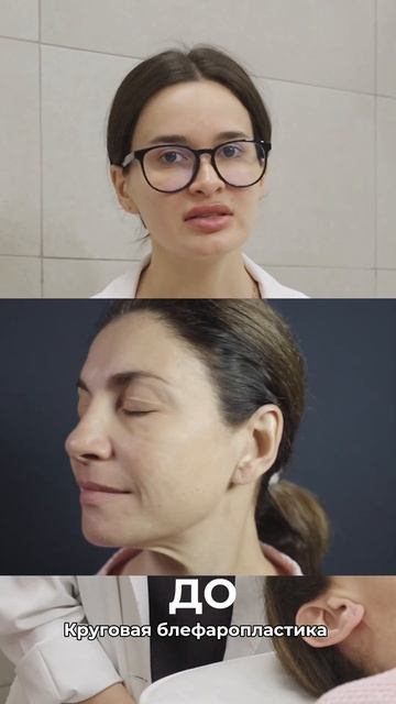 Анна  До круговой блефаропластики