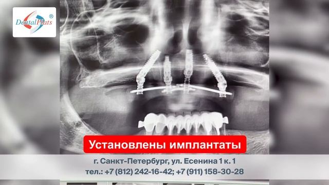 Протезирование на имплантатах