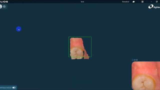 New function Helios 600 software — AI soft tissue removal