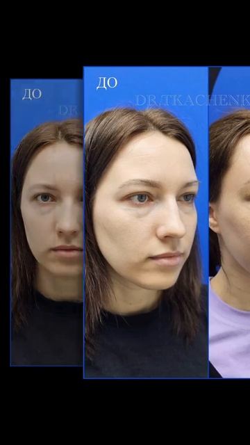 Эндоскопическая подтяжка лба, ранний результат 2 недели после операции.