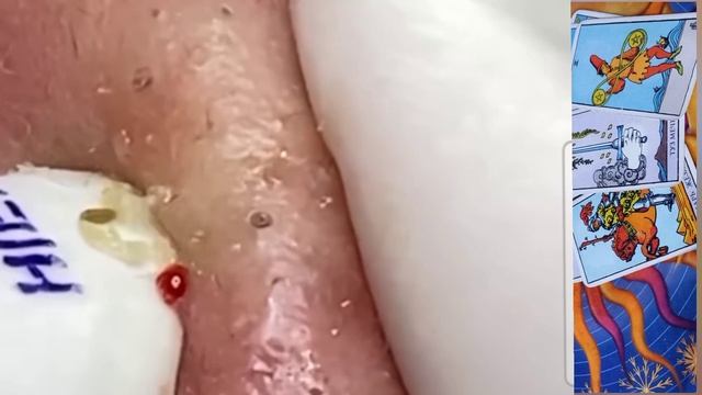 Смачные комедончики на лице👍