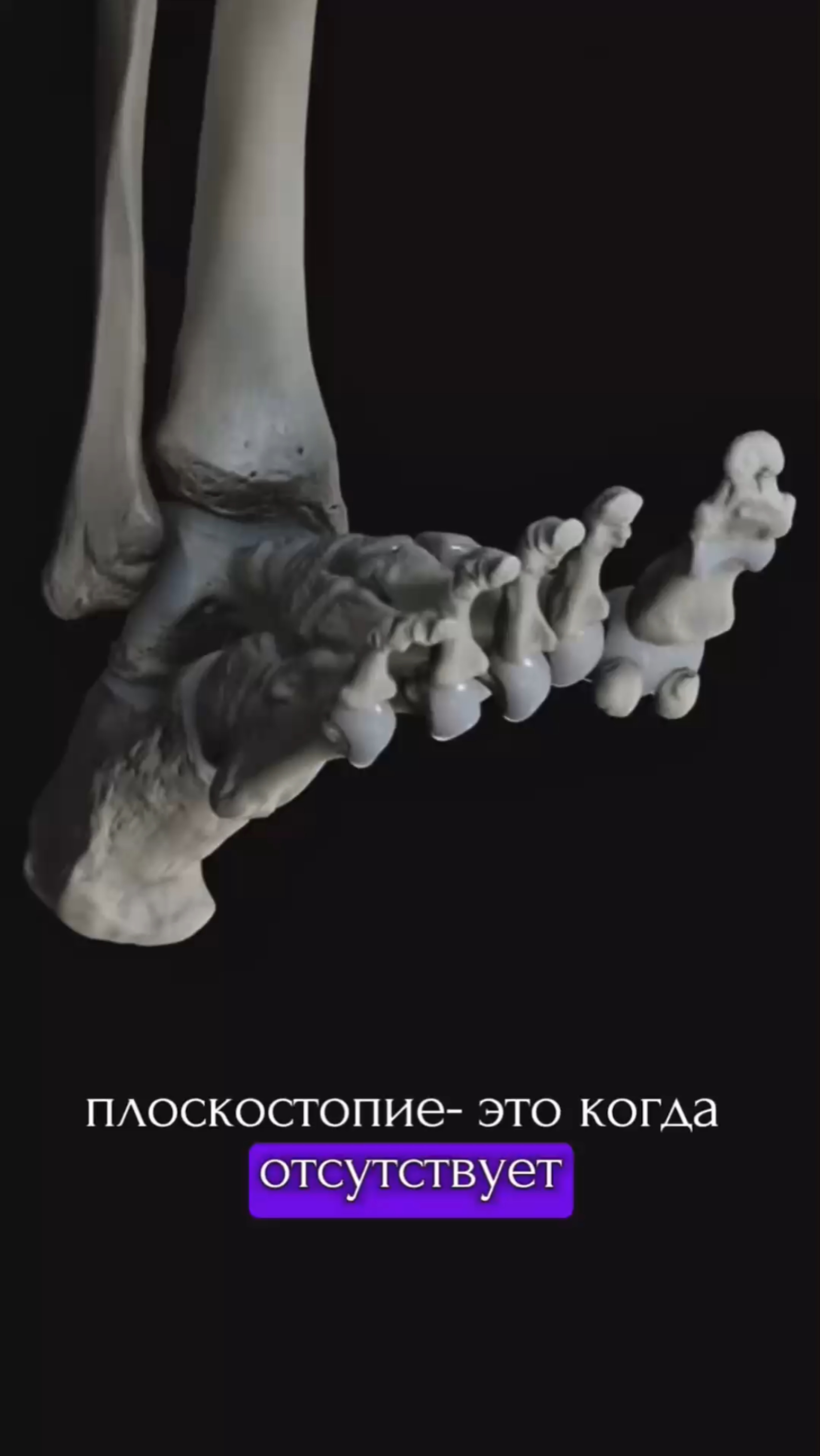 Плоскостопие и роль свода стопы в вашем здоровье 👣