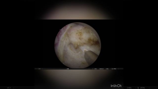 Опухоль в дивертикуле мочевого пузыря