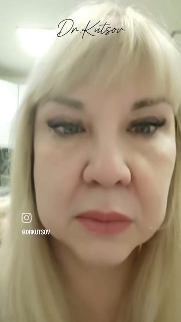 Результат верхней блефаропластики