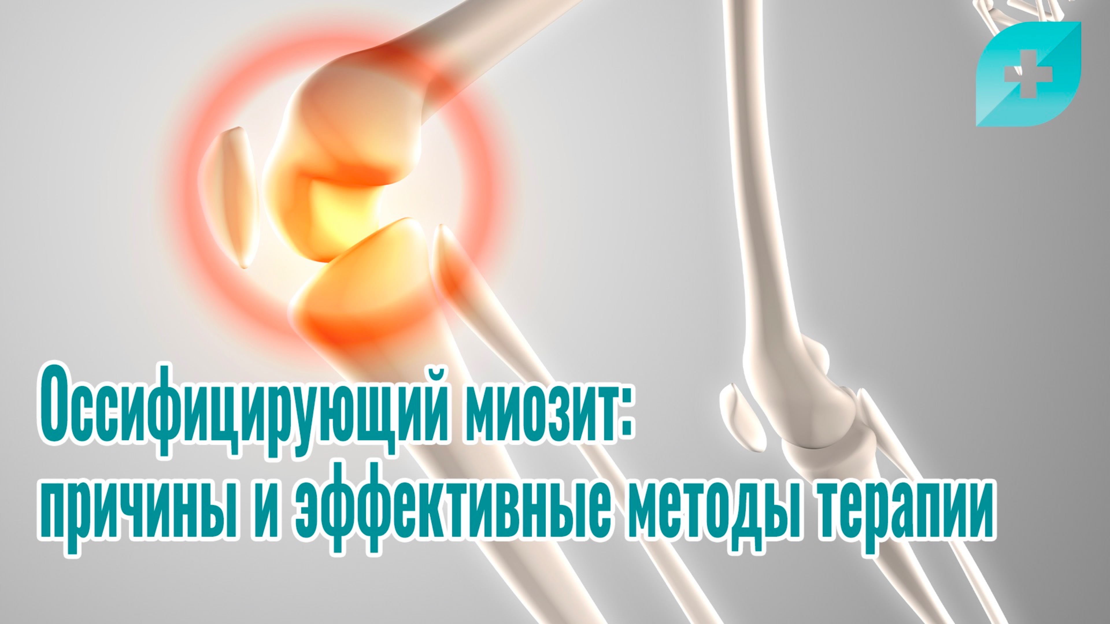 Оссифицирующий миозит: причины и эффективные методы терапии