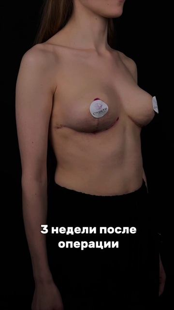 Якорная подтяжка без имплантов - великолепный результат спустя 3 недели после операции