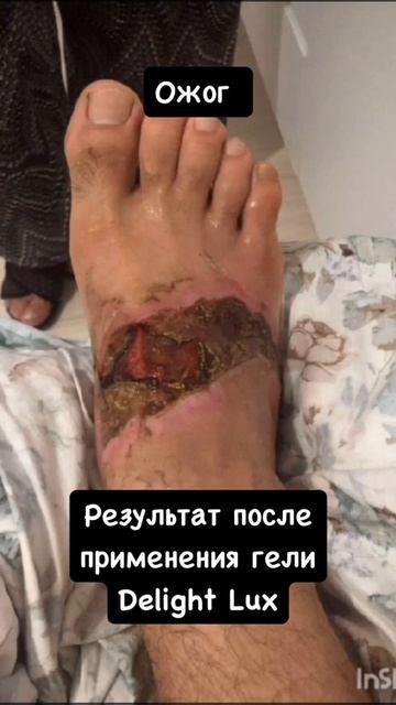 Ожог Нано бальзам 89177396793 консультация приобретения Глобал Тренд