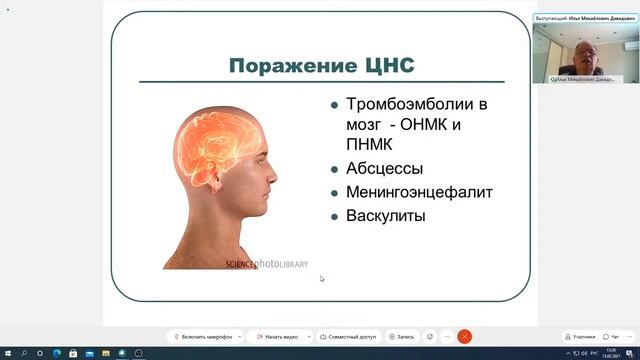 II 13. Инфекционные эндокардиты