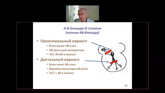 II 15. Блокады сердца