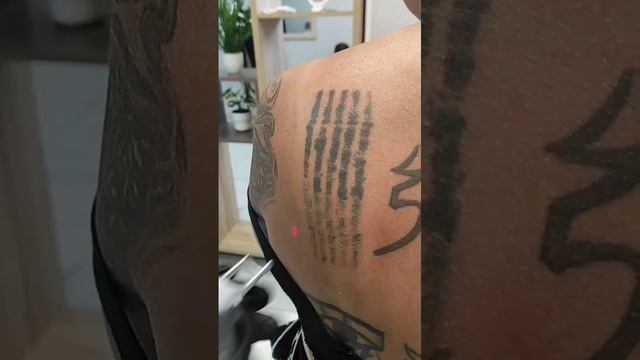 Удаление татуировки Пикосекундным лазером PicoWay