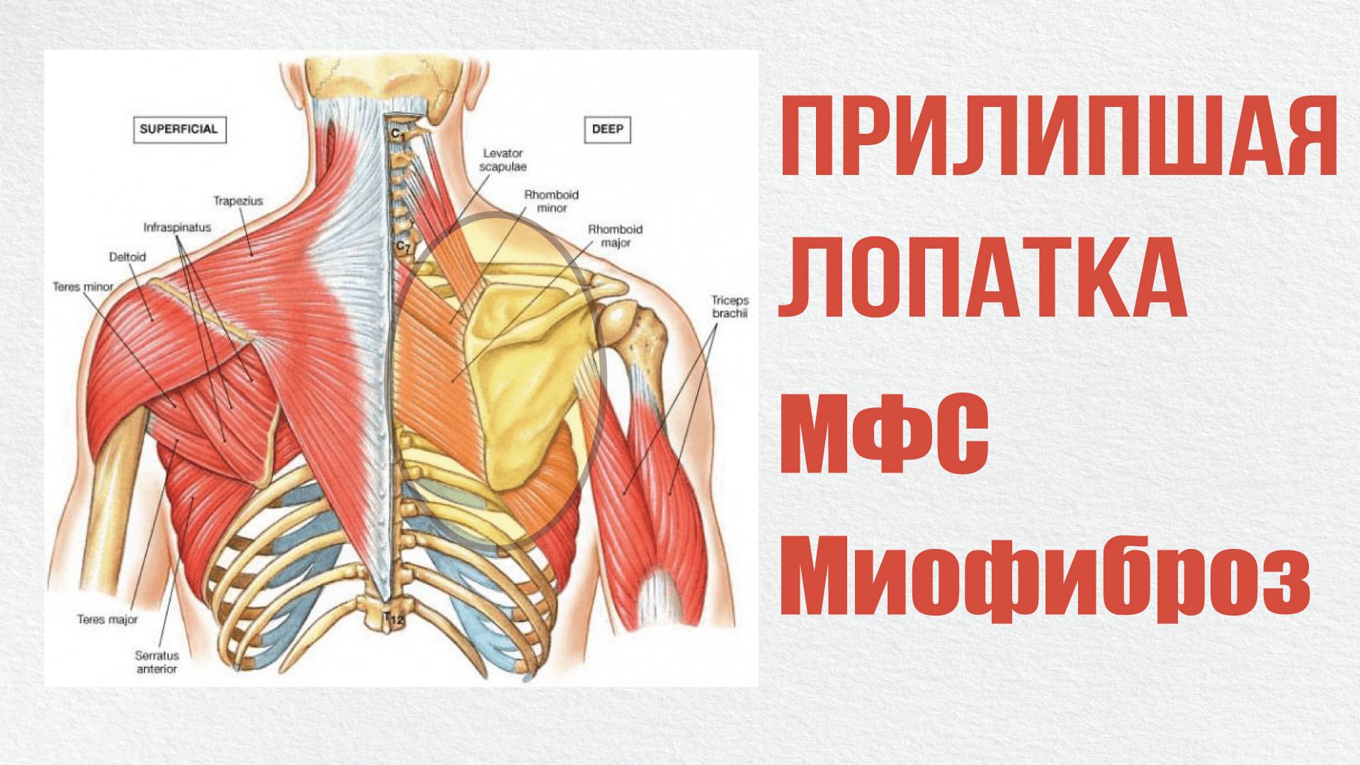 Прилипшая лопатка. Миофиброз. МФС.