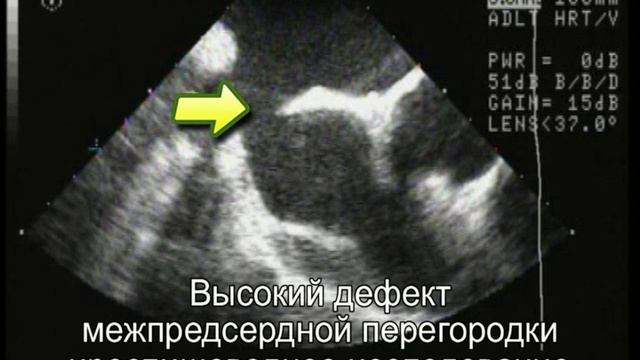 Высокий ДМПП (дефект венозного синуса)