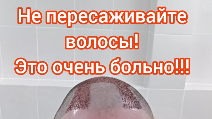 Пересадка волос - это больно? Посмотрите это видео, прежде чем идти в клинику!