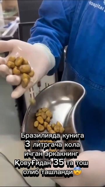 Бразилияда кунига 3 литргача кола ичган эркакнинг қовуғидан 35 та тош олиб ташланди.