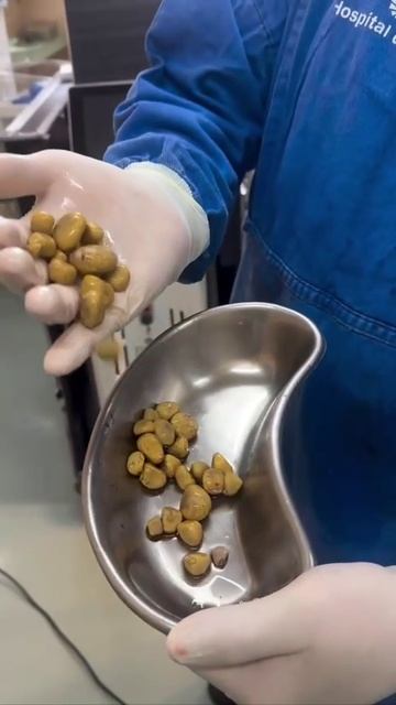 35 огромных камней извлекли из почек мужика, который пил по 2-3 литра колы в день