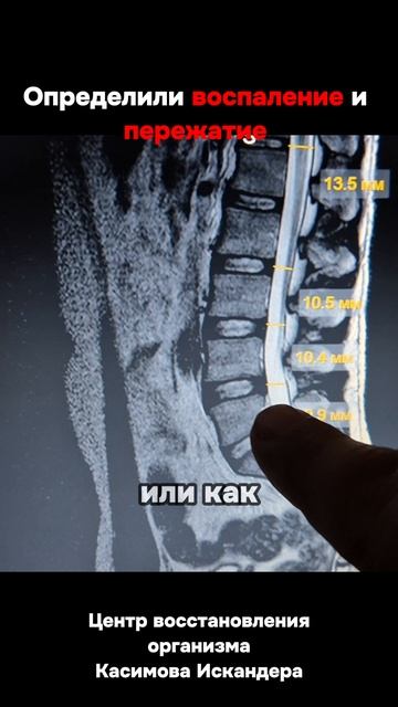 Забитый кишечник, воспаление, пережатие #польза #здоровье #лечение