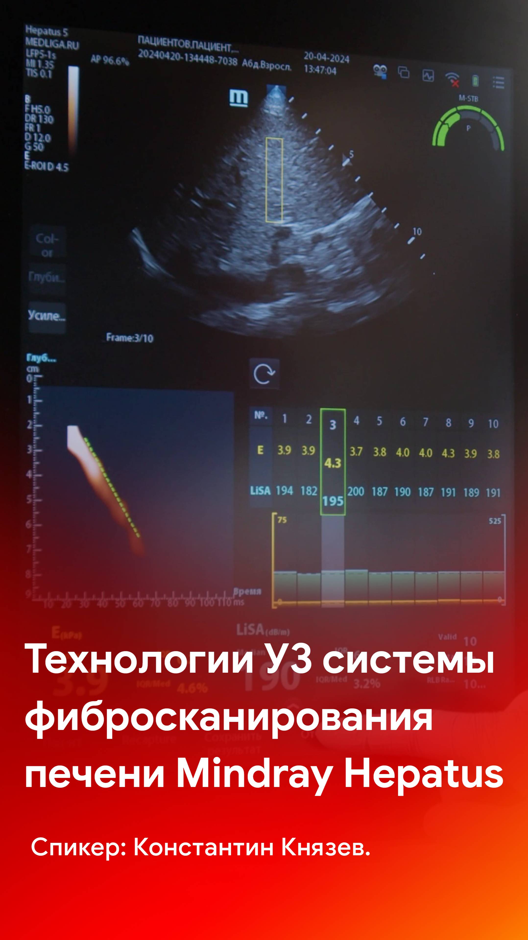 Технологии ультразвуковых систем фибросканирования печени Mindray Hepatus
