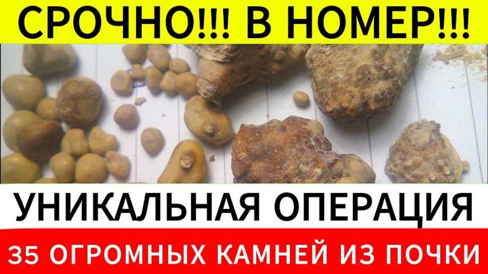 35 огромных камней из почки человека удалили с помощью уникальной операции