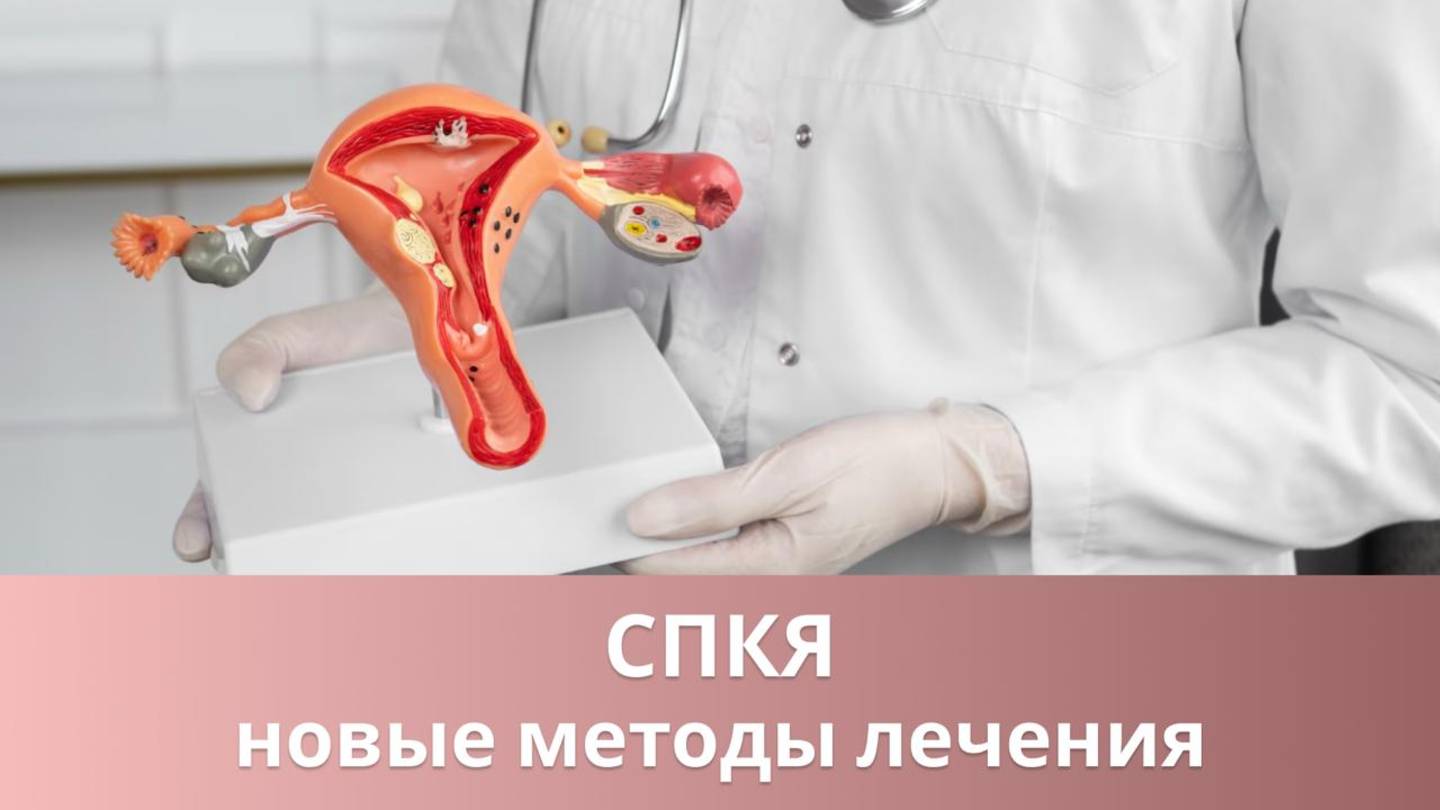 🔎 Как лечат синдром поликистозных яичников в 2025 году?