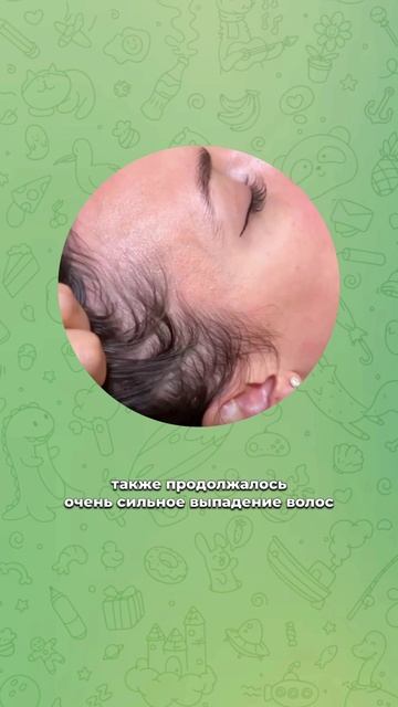 Волосы продолжают расти даже спустя 1,5 года после курса НеТЛАП

Никакого синдрома отмены