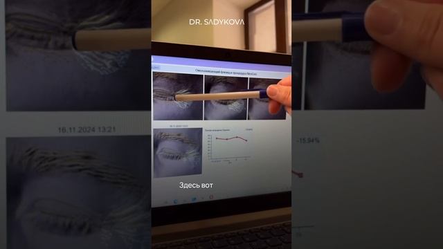 Ботокс-эффект с первого применения 🤌🏻