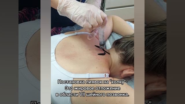Как избавиться от холки/ "вдовьего горбика"
