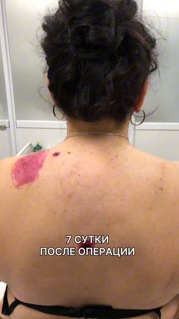 Липосакция холки. До и после операции.