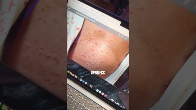 Как отличить акне от…