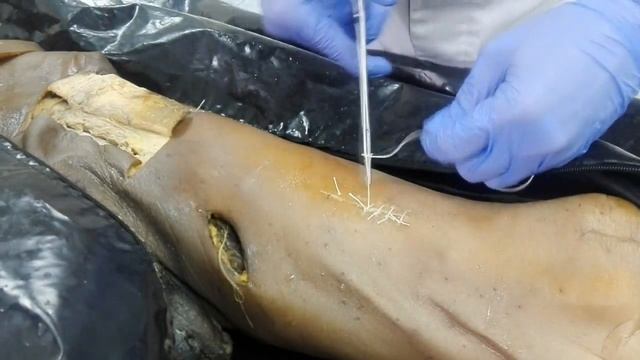 Простой узловой кожный шов.