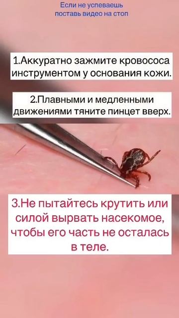 Как удалить клеща