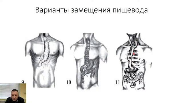 II 8. Рак пищевода