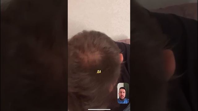 Невероятный результат пересадки волос #пересадкаволо