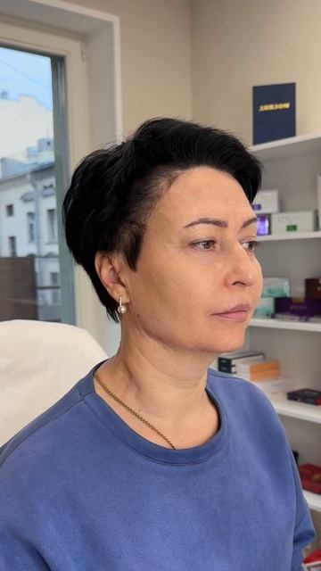 Подтяжка без операции