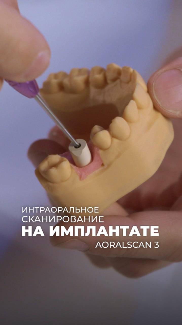 Сканирование с уровня имплантата с помощью сканмаркера
