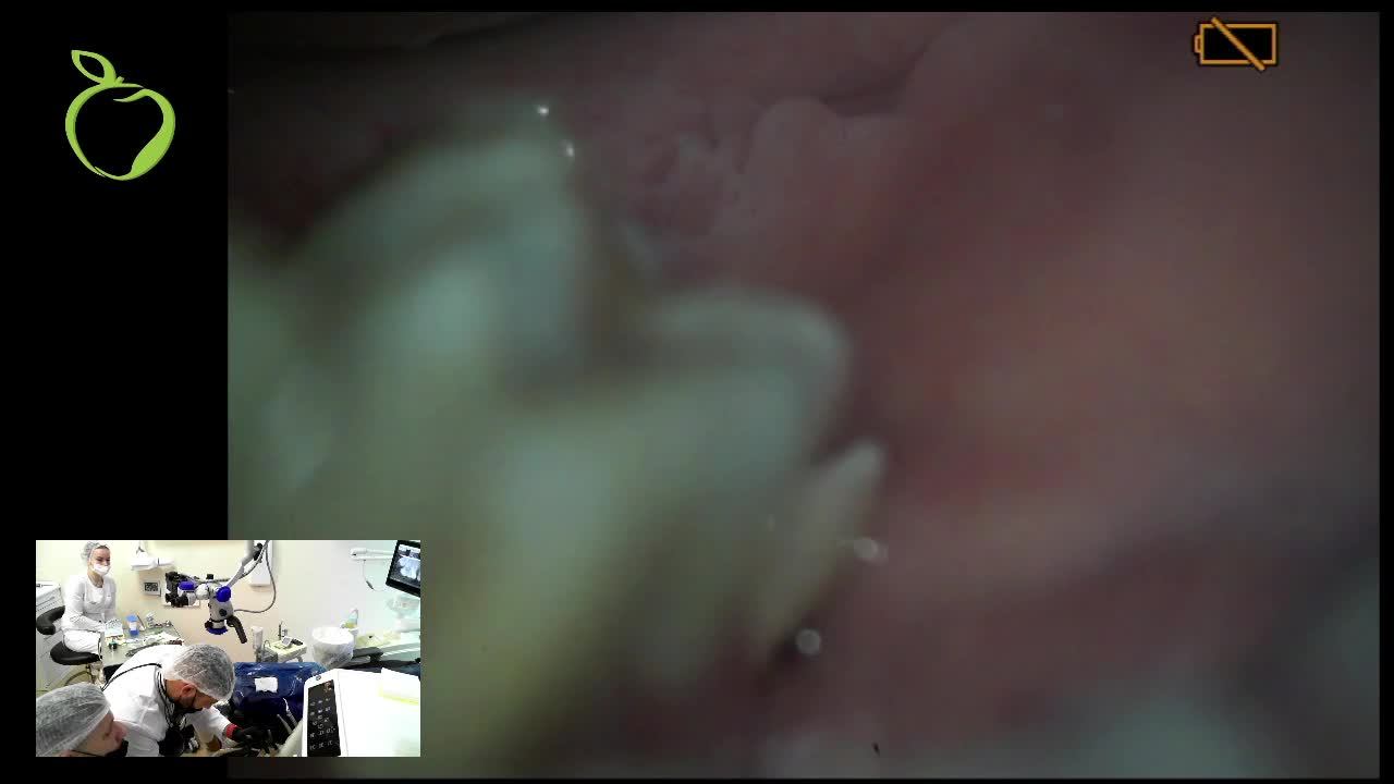 Извлечение инструмента из канала