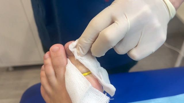 Удаление отдельно растущих фрагментов ногтя после ра?