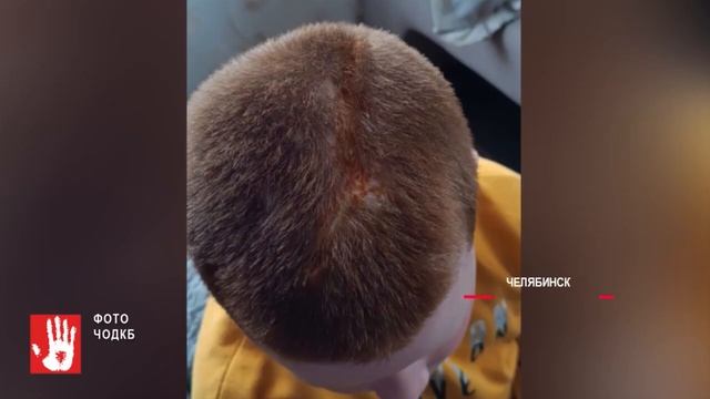 Челябинские врачи восстановили волосы ребенку после ?