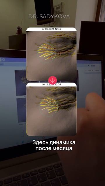 Лифтинг, заметный невооруженным взглядом 💯