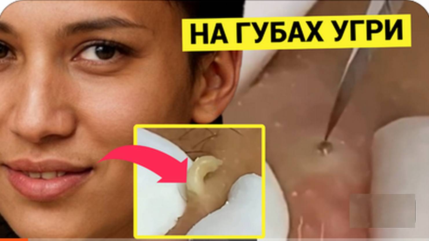 Выдавливание ПРЫЩЕЙ Жирных и Тягучих. Акне, Прыщи, Комедоны ДАВЯТСЯ ШИКАРНО в описании смотрите