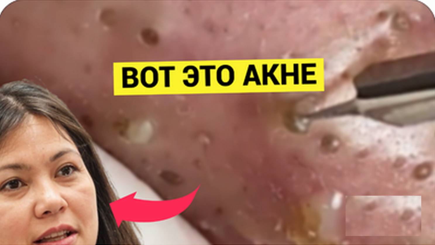 Девушка с НЕВЕРОЯТНЫМ Акне и Угрями Озадачила Косметолога. Прыщи и Черные Точки смешались на одной щ