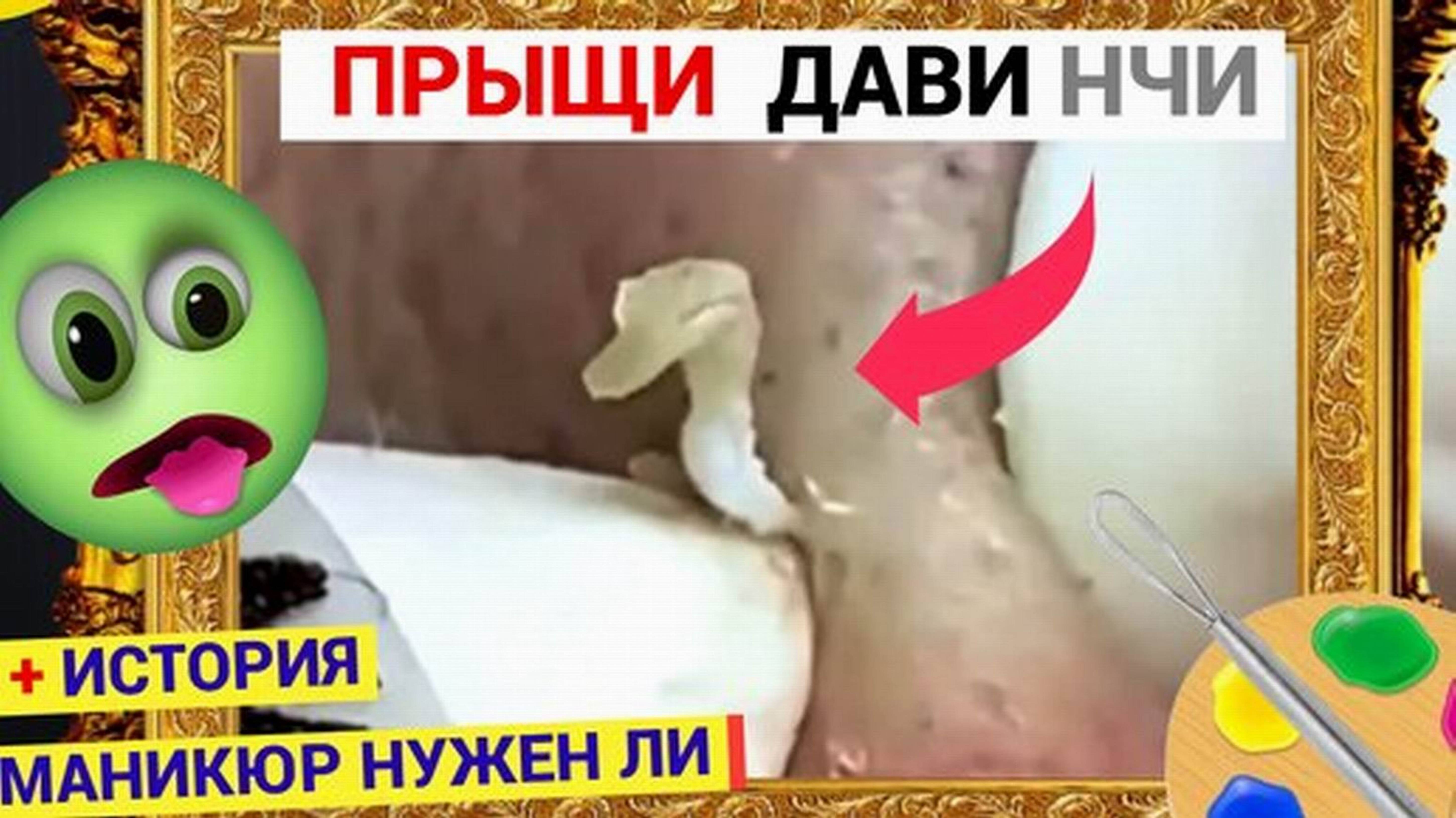 Прыщи 062 Комедон как ГУСЬ - такой же Важный. Выдавили его с уважением. Нужен ли маникюр и стоит ли