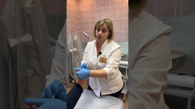 Прижигание бородавки.