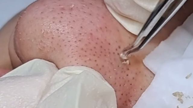 Механическая чистка носа. Черные точки
