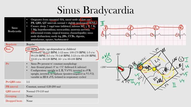 35.Sinus Bradycardia