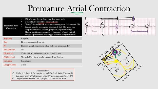 39.Premature Atrial Contraction