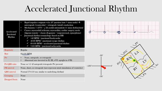48.Accelerated Junctional Rhythm
