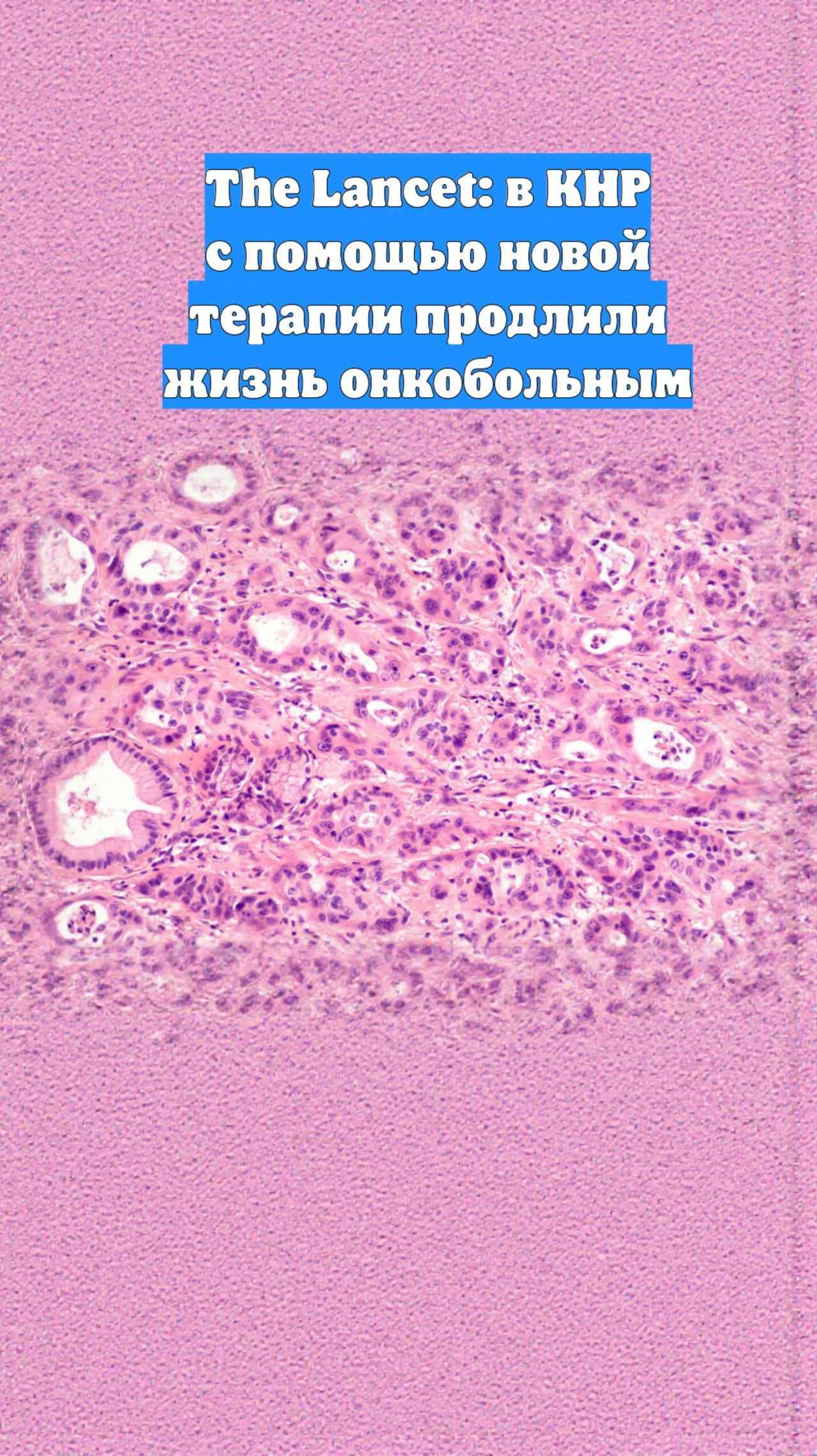 The Lancet: в КНР с помощью новой терапии продлили жизнь онкобольным